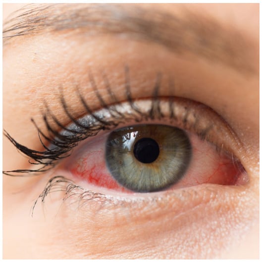 A close-up image of a woman's visibly dry and red eye before OptiLight treatment.