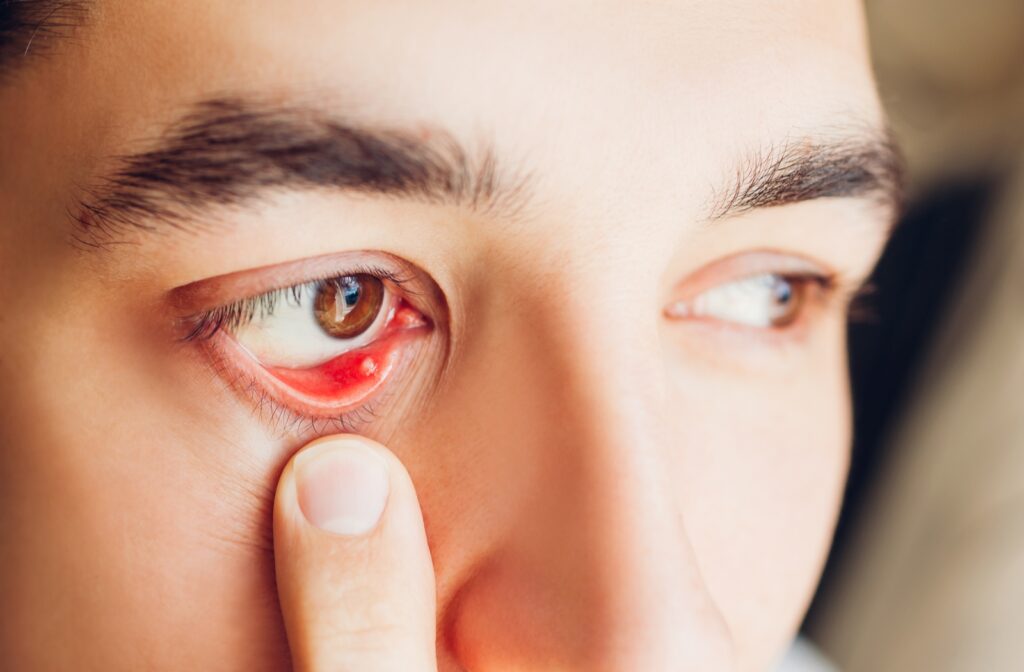 A person pulling down their right eyelid with their finger to show their inflamed meibomian glands