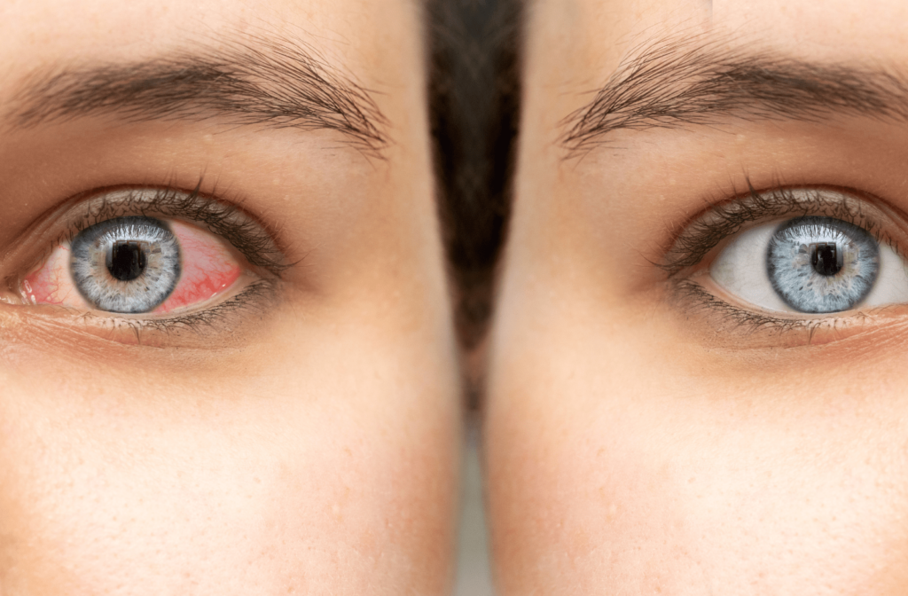 A woman's red eye compared to a healthy, clear eye