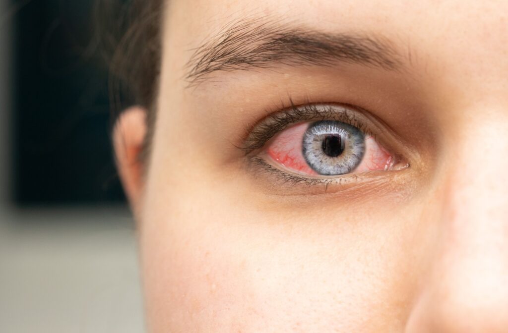 Close up of woman's blood shot eye, pink eye.