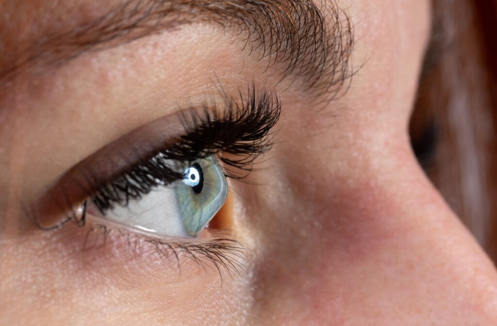 A close-up photo of a patient's irregularly shaped cornea due to keratoconus.