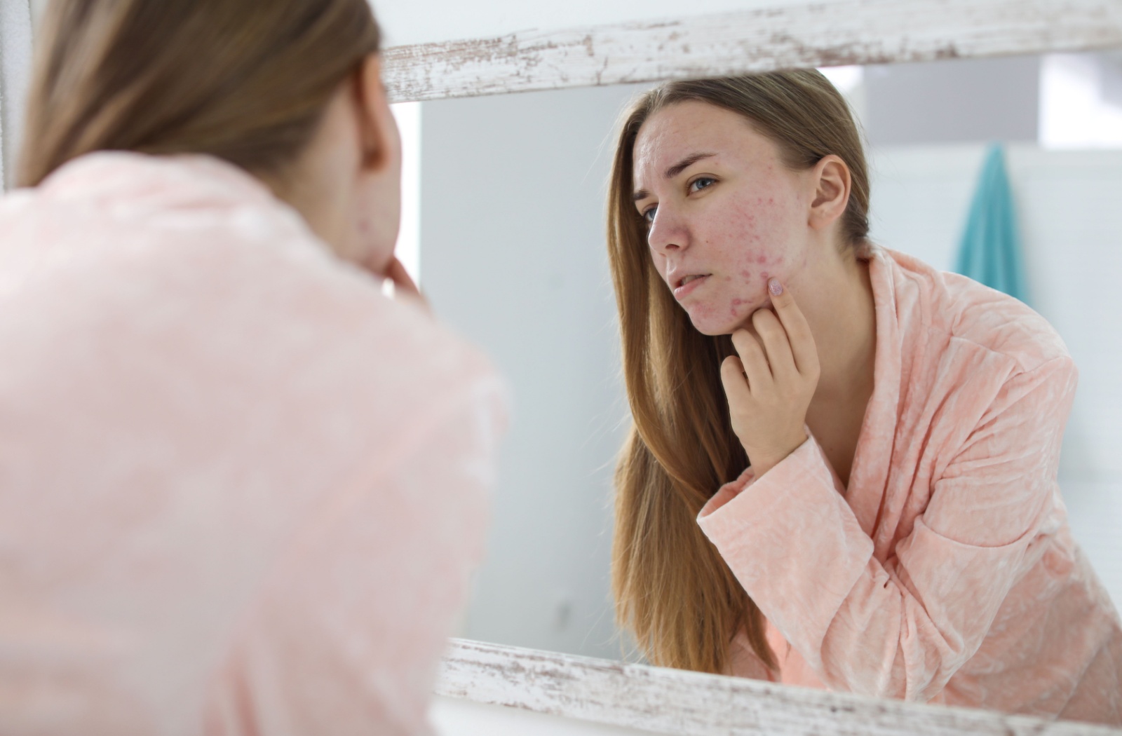 A person with acne examines their skin in the mirror.